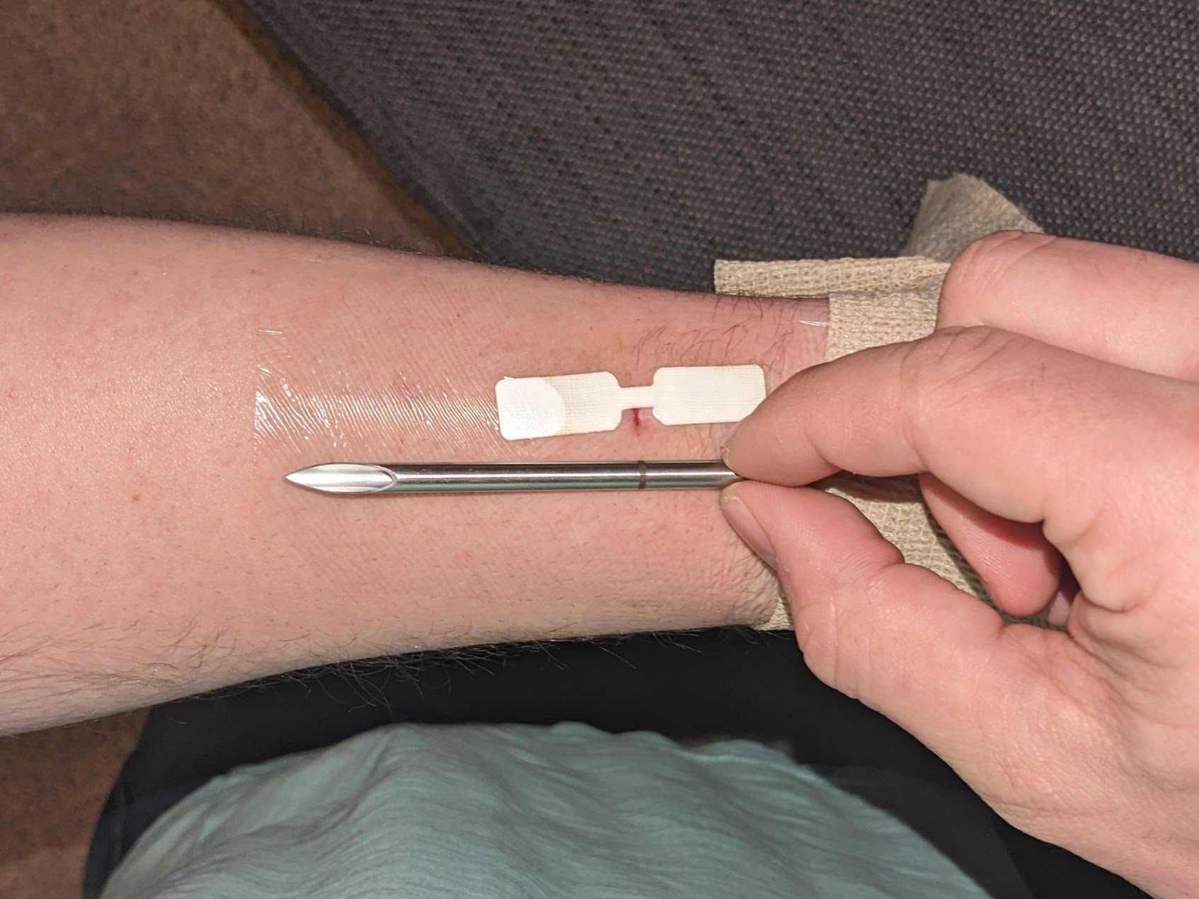 The needle is inserted and advanced up to the black marker, removed, and the chip is fed in.
